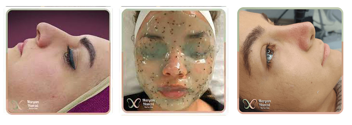 فشیال صورت در سالن زیبایی مریم حمزه ای