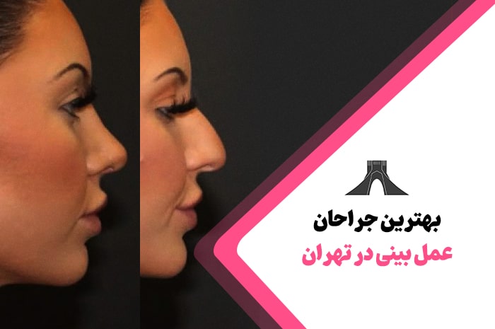 بهترین جراحان بینی در تهران