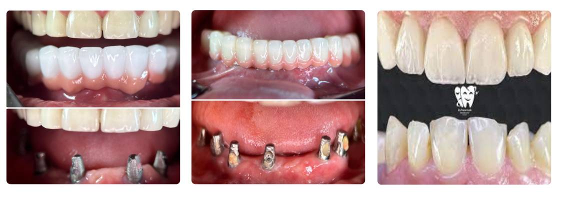 دکتر پدرام عبدالهه زاده در ایمپلنت دندان