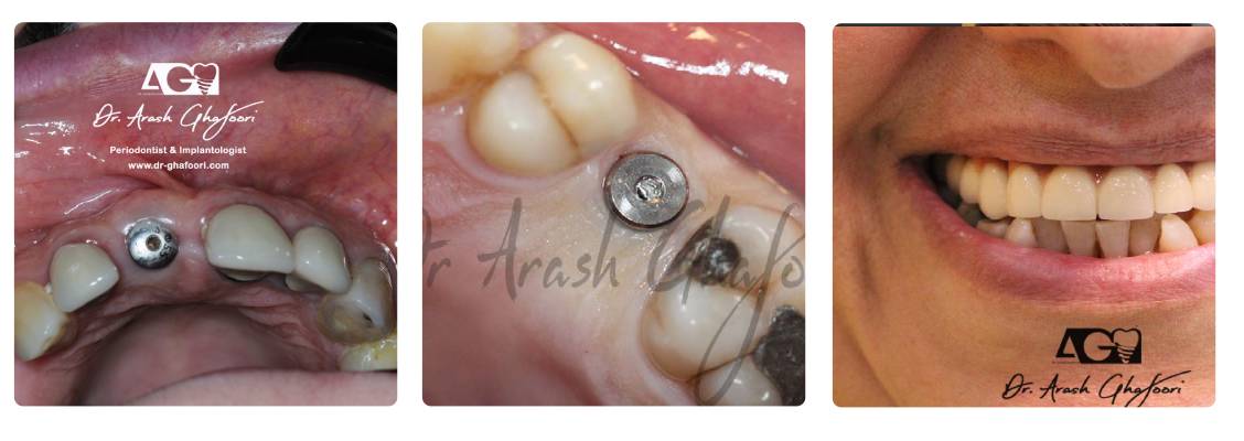 ایمپلنت دندان دکتر غفوری