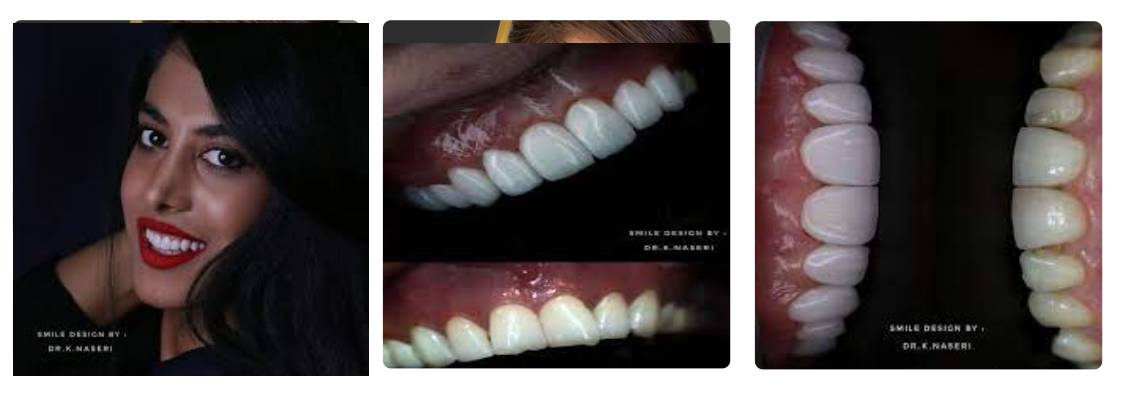 دکتر کسری ناصری در کامپوزیت دندان