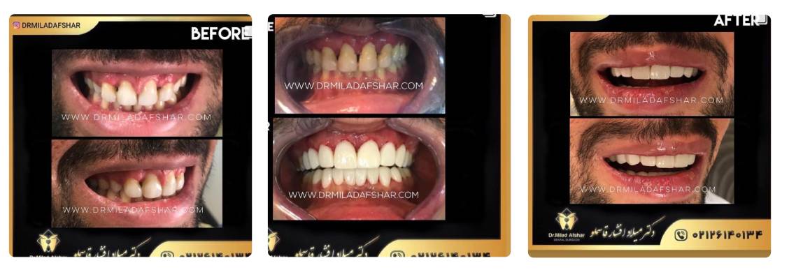 لمینت دکتر میلاد افشار