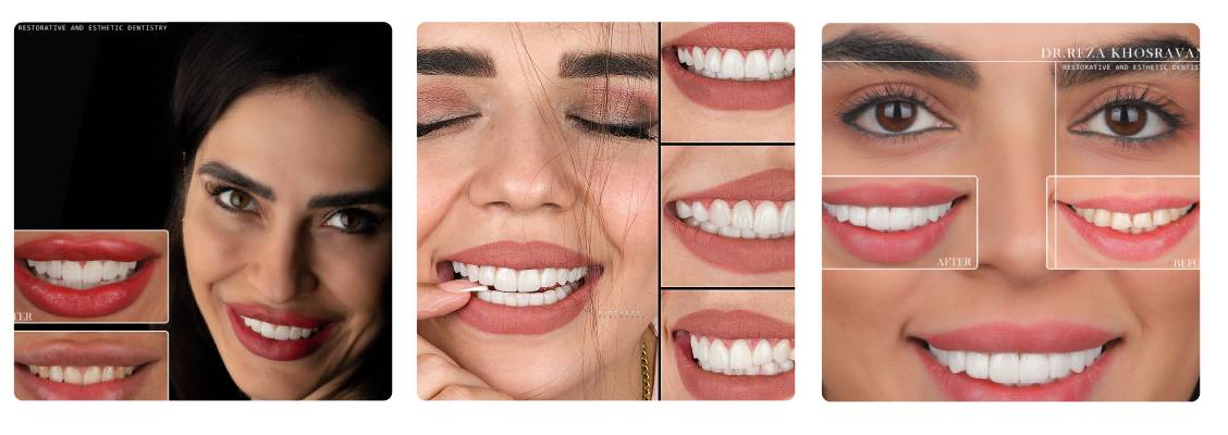 دکتر رضا خسروانی در لمینت دندان