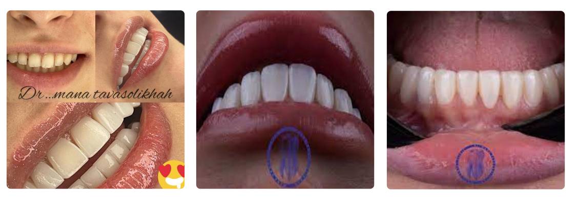 متخصص کامپوزیت دندان دکتر مانا توسلی خواه