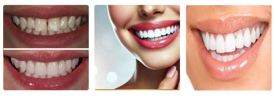 کامپوزیت دندان دکتر میلاد لاریجانی