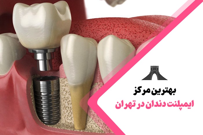 بهترین مرکز ایمپلنت دندان در تهران