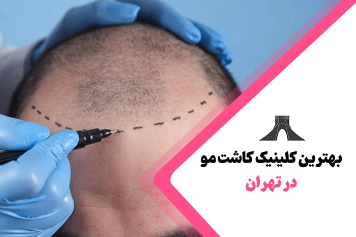 بهترین کلینیک کاشت مو در تهران