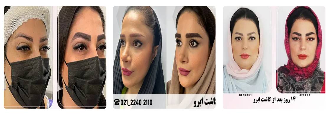 کلینیک کاشت مو چهره شو