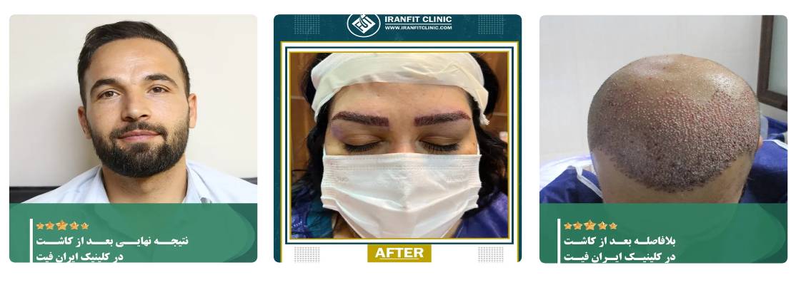 کلینیک کاشت مو ایران فیت