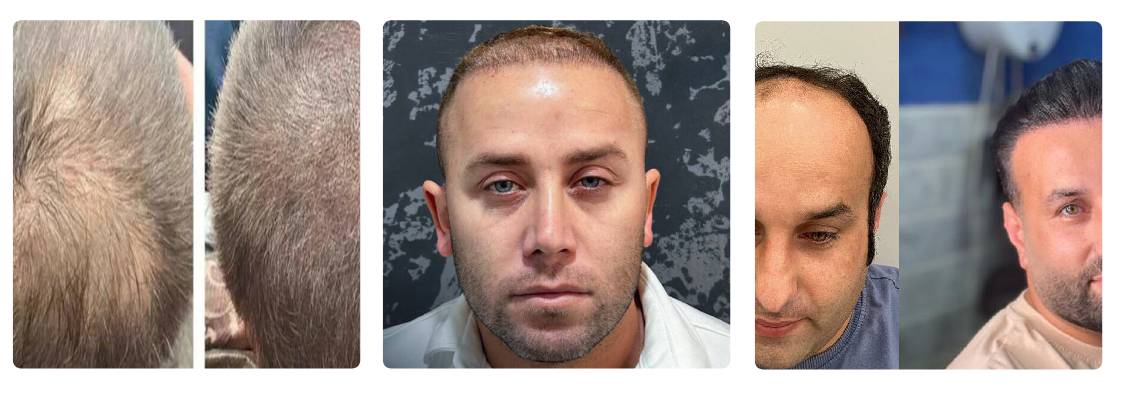 کلینیک کاشت مو تهران کاشت