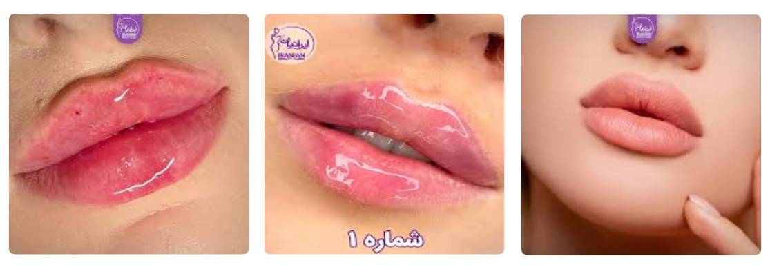 تزریق ژل لب در کلینیک ایرانیان