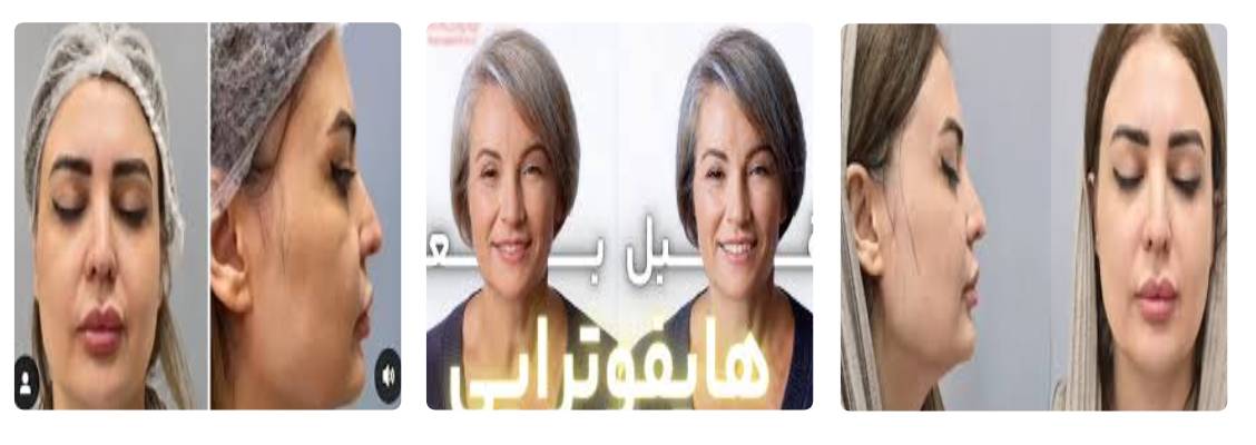 کلینیک مه نگاه مرکز هایفوتراپی تهران