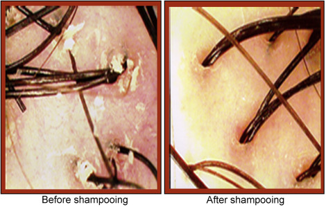 استفاده صحیح از شامپو