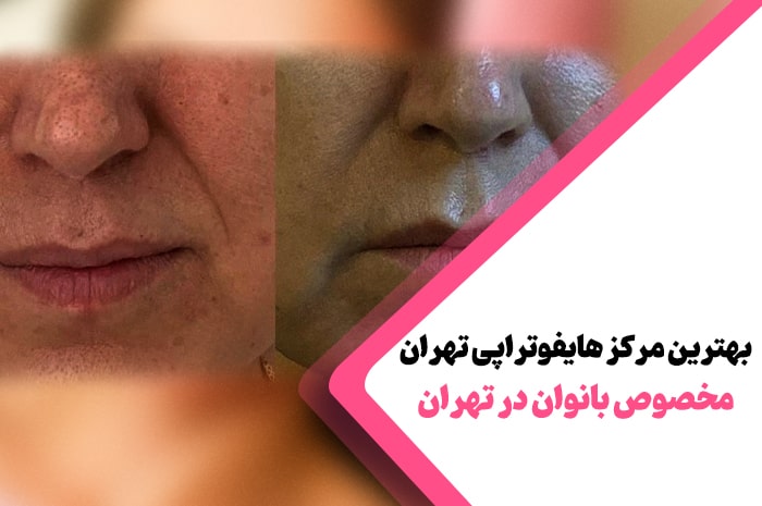بهترین مرکز هایفوتراپی تهران