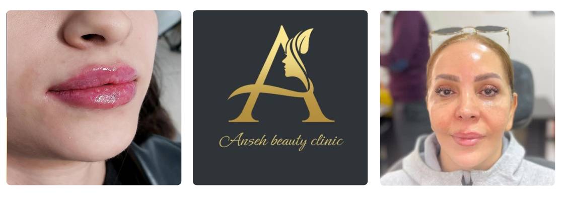 کلینیک زیبایی آنسه بهترین مرکز بوتاکس در کرج