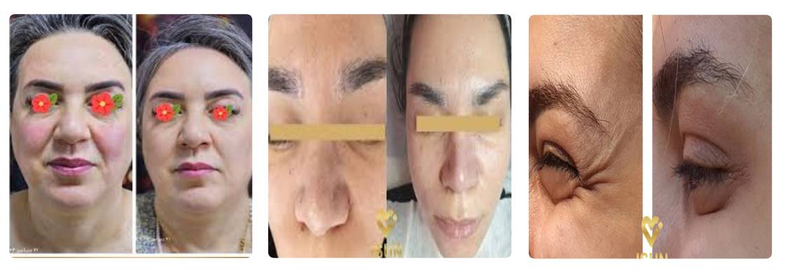 کلینیک زیبایی آیسان بهترین مرکز بوتاکس در کرج